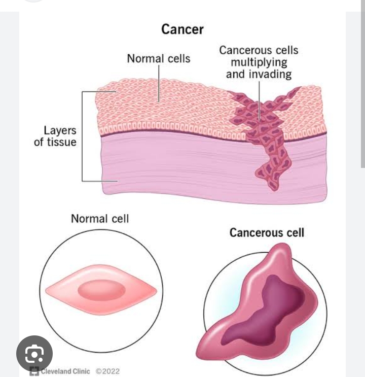 The severity of cancer. 